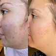 [Sebo-Regul] Anti-Blemish Serum 30 ml