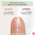 Nail Corrector Poderm