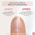 Nail Corrector Poderm